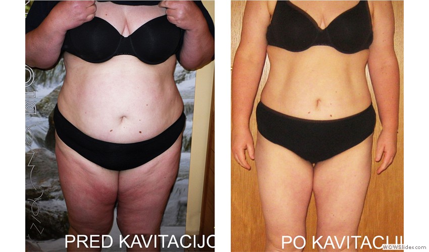 Rezultati kavitacije